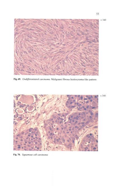 Histological Typing of Thyroid Tumours - libdoc.who.int - World ...