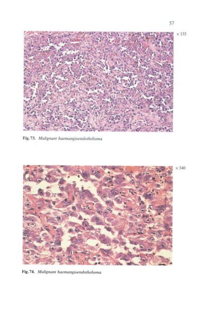 Histological Typing of Thyroid Tumours - libdoc.who.int - World ...