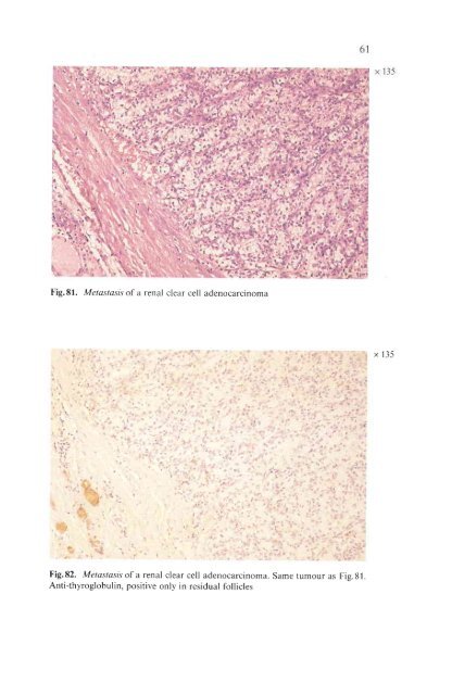 Histological Typing of Thyroid Tumours - libdoc.who.int - World ...