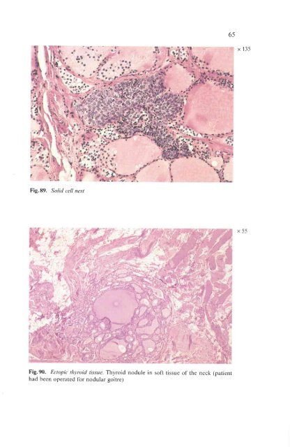 Histological Typing of Thyroid Tumours - libdoc.who.int - World ...