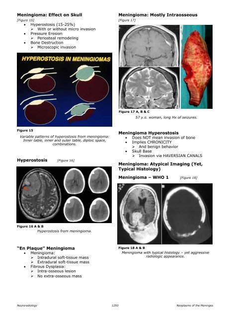 Neoplasms of the Meninges James G. Smirniotopoulos, MD