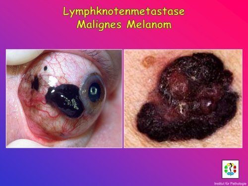 Allgemeine Pathologie Schnittkurs AP8 Metastasen