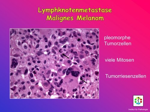 Allgemeine Pathologie Schnittkurs AP8 Metastasen