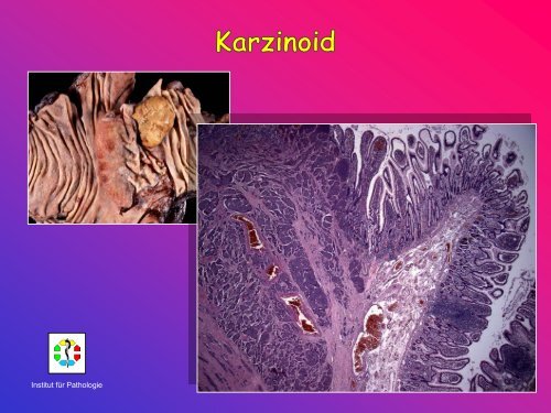 Allgemeine Pathologie Schnittkurs AP8 Metastasen