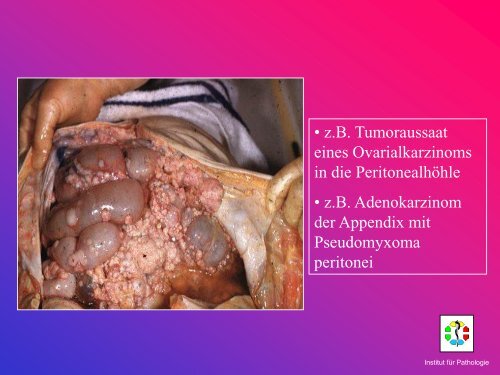 Allgemeine Pathologie Schnittkurs AP8 Metastasen