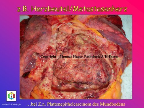 Allgemeine Pathologie Schnittkurs AP8 Metastasen