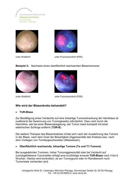 Krebszellen Im Urin Nachz