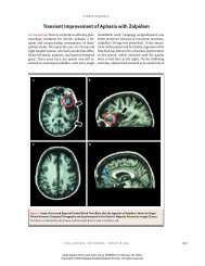 Transient Improvement of Aphasia with Zolpidem