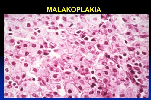 UROTHELIAL CARCINOMA