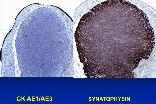 UROTHELIAL CARCINOMA