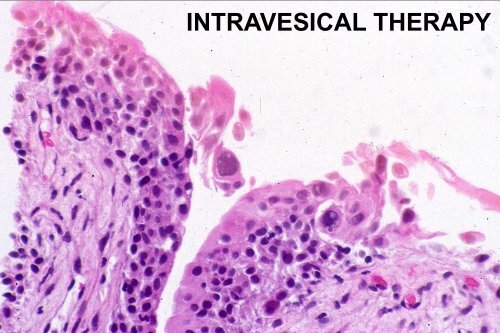 UROTHELIAL CARCINOMA