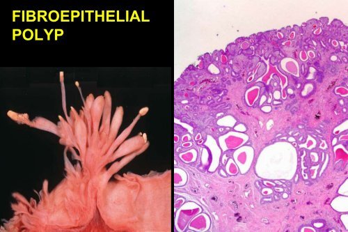 UROTHELIAL CARCINOMA