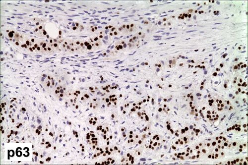 UROTHELIAL CARCINOMA