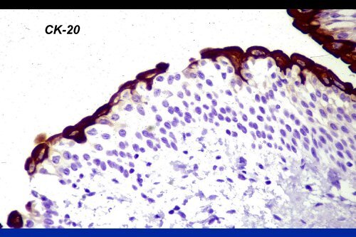 UROTHELIAL CARCINOMA