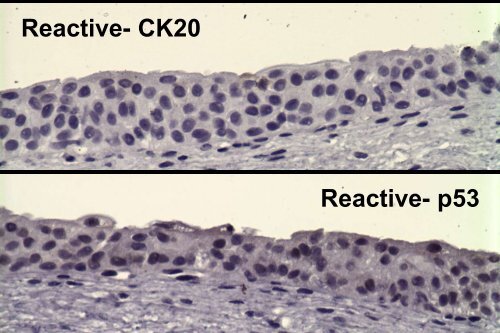 UROTHELIAL CARCINOMA