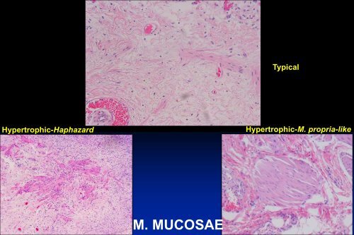 UROTHELIAL CARCINOMA