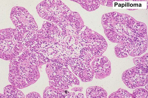 UROTHELIAL CARCINOMA