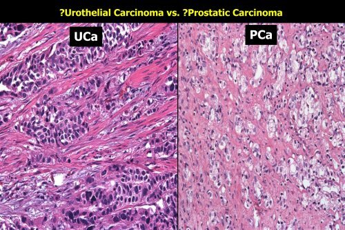 UROTHELIAL CARCINOMA