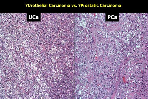 UROTHELIAL CARCINOMA