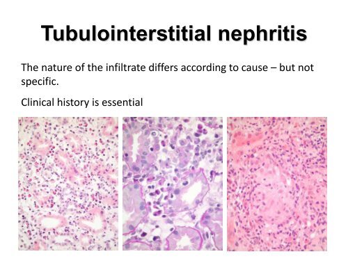 UROTHELIAL CARCINOMA