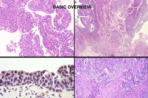 UROTHELIAL CARCINOMA