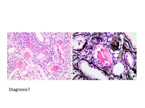 UROTHELIAL CARCINOMA