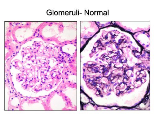 UROTHELIAL CARCINOMA