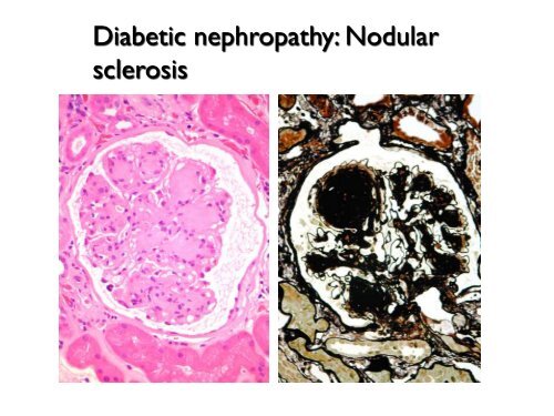 UROTHELIAL CARCINOMA