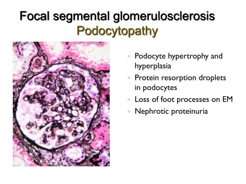 UROTHELIAL CARCINOMA