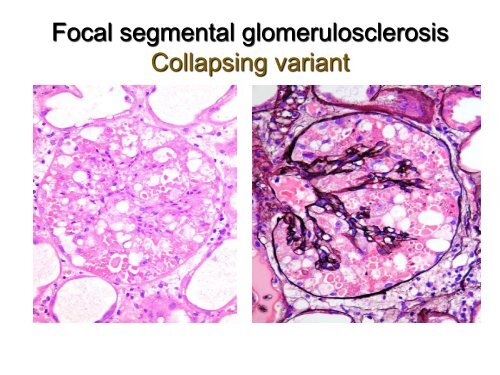 UROTHELIAL CARCINOMA