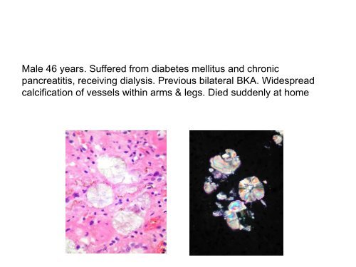 UROTHELIAL CARCINOMA