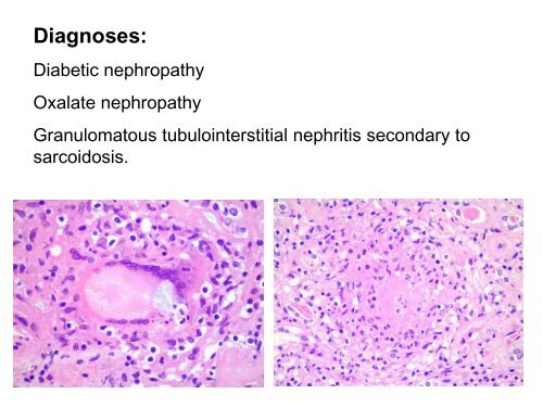 UROTHELIAL CARCINOMA