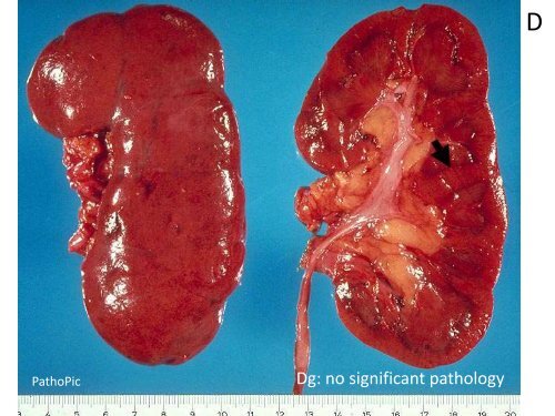 UROTHELIAL CARCINOMA