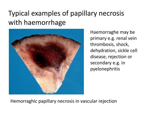 UROTHELIAL CARCINOMA