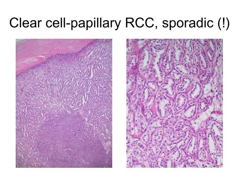 UROTHELIAL CARCINOMA