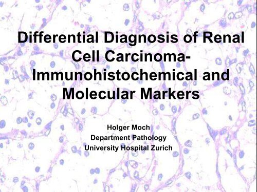 UROTHELIAL CARCINOMA