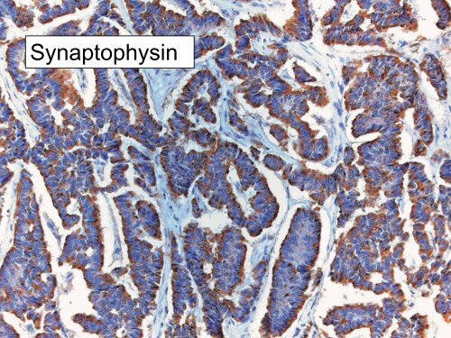 UROTHELIAL CARCINOMA