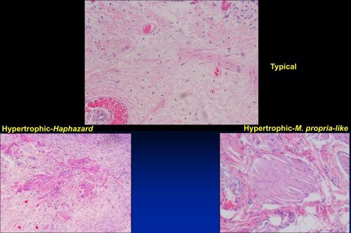 UROTHELIAL CARCINOMA