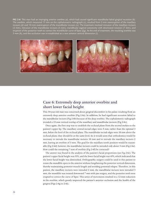 altering vertical dimension in the perio-restorative patient - Kokich ...