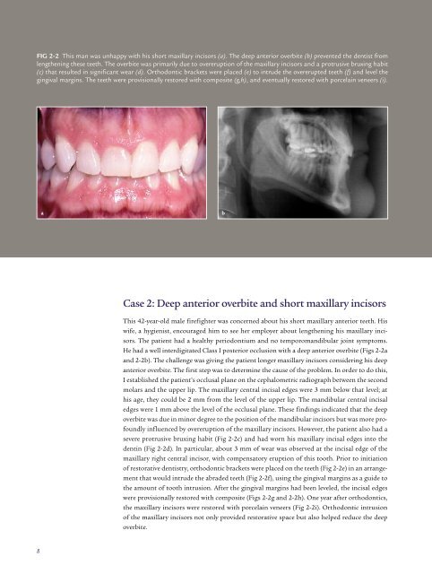 altering vertical dimension in the perio-restorative patient - Kokich ...