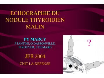 ECHOGRAPHIE DU NODULE THYROIDIEN MALIN