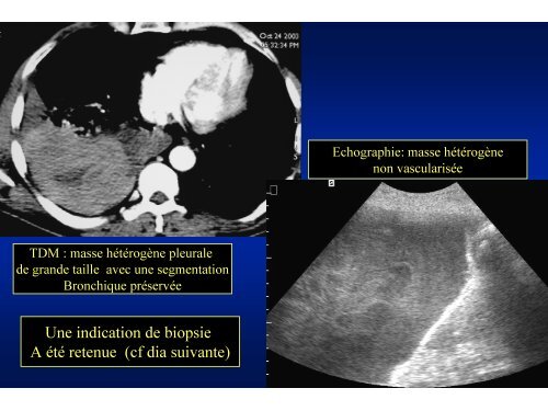 Epaississement pleural