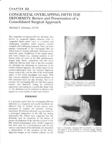 Congenital Overlapping Fifth Toe Deformity - The Podiatry Institute