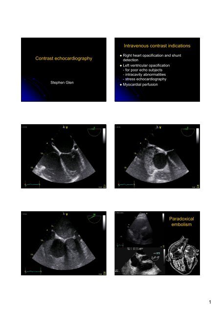 Contrast Echocardiography - Dr Stephen Glen