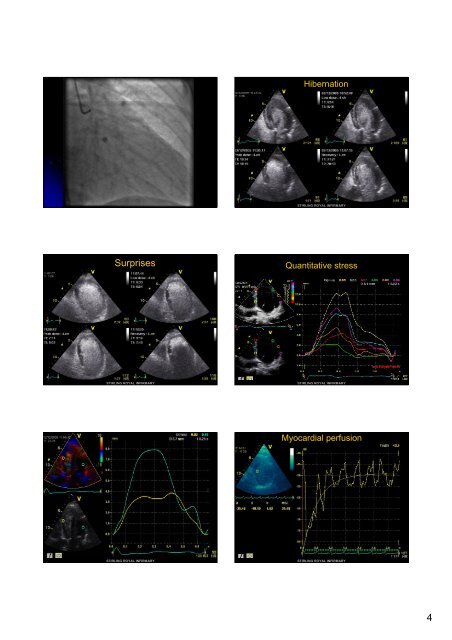 Contrast Echocardiography - Dr Stephen Glen