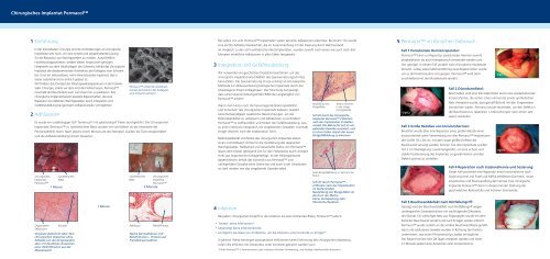 Permacolâ¢ Chirurgisches Implantat FÃ¶rdert das Konzept der ...