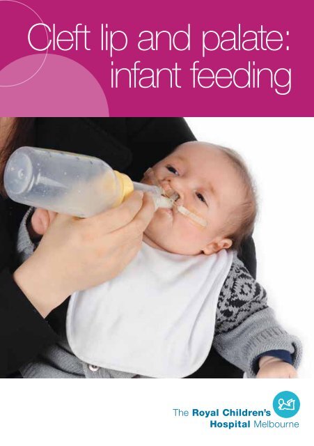 Cleft lip and palate: infant feeding - The Royal Children's Hospital
