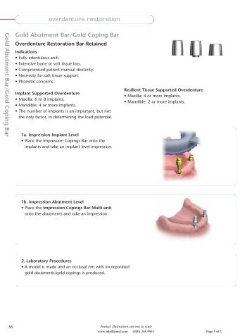 Nobel Overdenture Bar Attachment - Udell dental laboratory