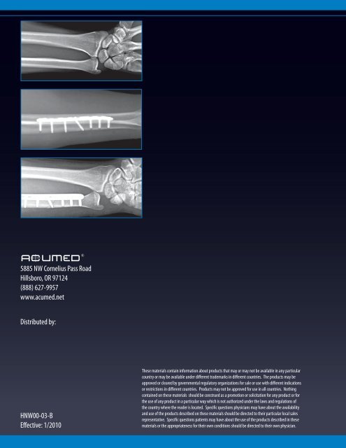 Acumed Ulna Shortening System.pdf - Osteosyntese