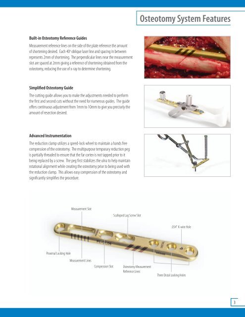 Acumed Ulna Shortening System.pdf - Osteosyntese